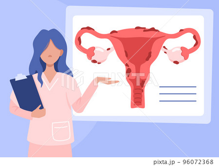 Illustration of the uterus and endometriosis. Doctor explains the results of a gynecological examination. Womens diseases and prevention of womens health. Vector illustration Illustration of the uterus and endometriosis. Doctor explains the results of a gynecological examination. Womens diseases and prevention of womens health. Vector illustration 96072368