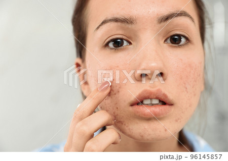 Teen girl applying acne healing patch, closeup Teen girl applying acne healing patch, closeup 96145857
