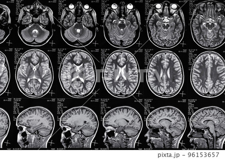 High resolution magnetic resonance image scan of brain epi syndrome. Real MRI scan of head, close up. High resolution magnetic resonance image scan of brain epi syndrome. Real MRI scan of head, close up. 96153657