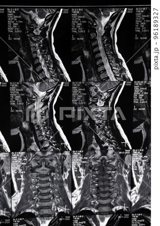High resolution MRI scan of cervical spine. Real spine MRI scan. High resolution MRI scan of cervical spine. Real spine MRI scan. 96189327