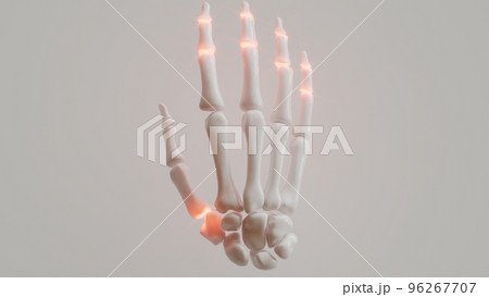 Polyarthrosis on white background - 3D renderingのイラスト素材 [96267707] - PIXTA