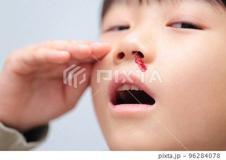 鼻血が出る小学生の女の子 (血のりでイメージ) 鼻血が出る小学生の女の子 (血のりでイメージ) 96284078