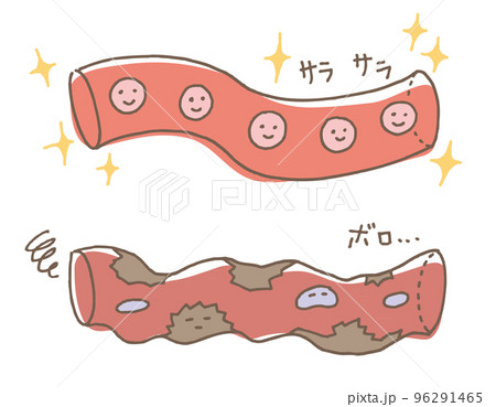 健康な血管　錆びた血管（線画別カラー） 96291465