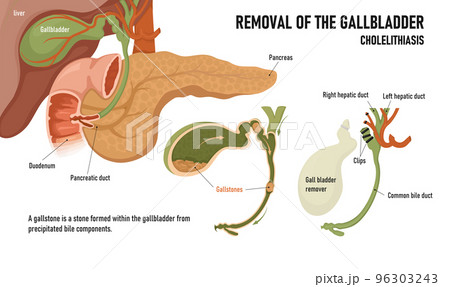 Cholecystitis. Inflammation of the gallbladder and bile ducts. Gallstones. Removal of the gallbladder 96303243