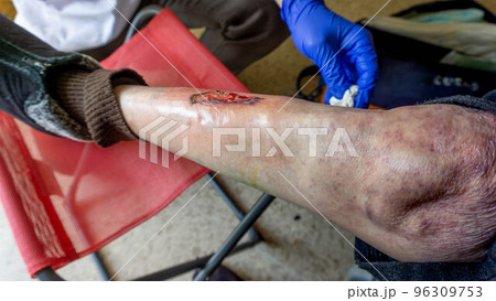 varicose ulcer on one leg varicose ulcer on one leg 96309753