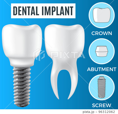 Realistic white dental implant and human tooth. Dentistry, medicine and oral cavity health Realistic white dental implant and human tooth. Dentistry, medicine and oral cavity health 96312062