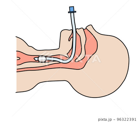 気管内チューブ 96322391