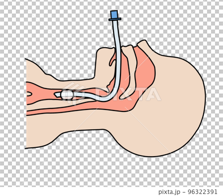 endotracheal tube 96322391