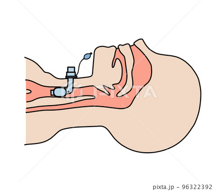 気管切開チューブ 96322392