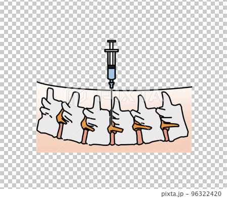 nerve root block nerve root block 96322420