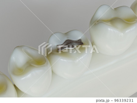 Amalgam restorationn in a tooth - 3D Rendering Amalgam restorationn in a tooth - 3D Rendering 96339231