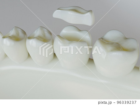 Ceramic Inlay crown over a tooth- 3D Rendering 96339237