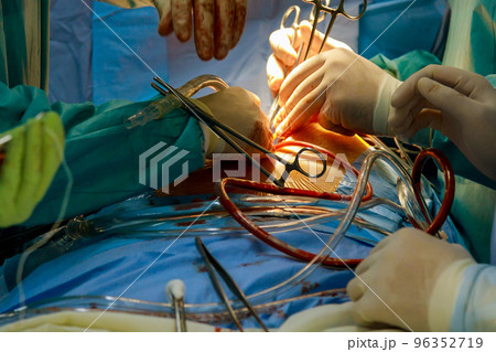 Coronary artery bypass graft CABG for heart operations due to disease coronary heart disease in hospital operation room 96352719