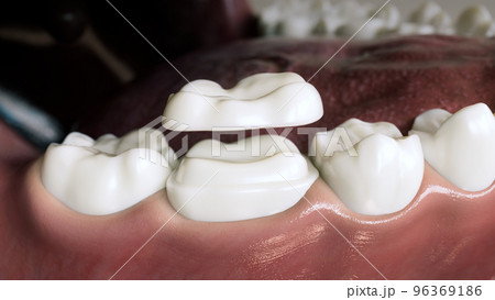 Ceramic Overlay crown over a tooth- 3D Rendering 96369186