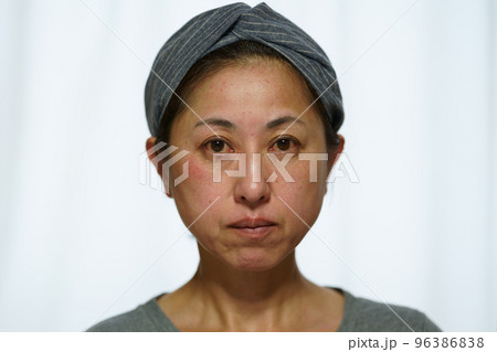 顔に吹き出物、赤みが出た中年女性　 96386838