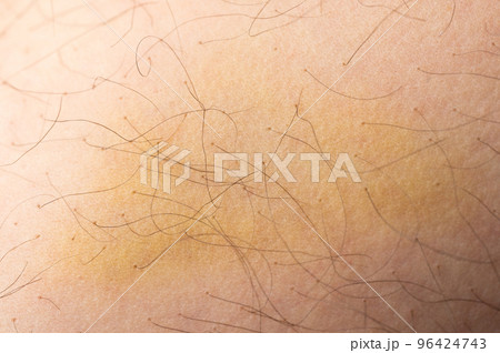 Injured human skin Injured human skin 96424743