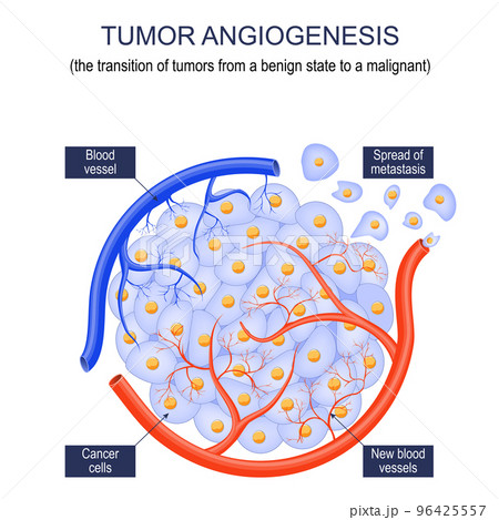 Tumor angiogenesis 96425557