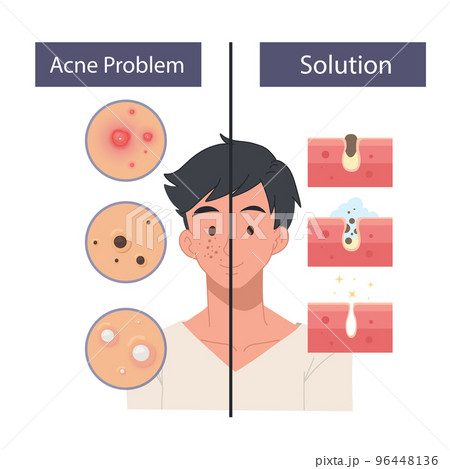 Face Care Men concept. Facial care, skin defects, skin problems, acne, facials. Facial care icons. 96448136