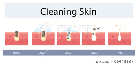 Facial skin care, pore cleaning concept. Cleansing stages on clogged face. Skin cleaning steps. Vector illustration. 96448137