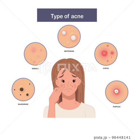 Infographic of Type of acne, sad and worried woman with acne. Flat vector illustration 96448141