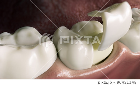 Ceramic Onlay quarter crown over a tooth- 3D Rendering 96451348