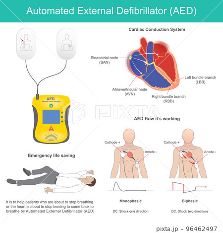 Automated External Defibrillator. It is electronic device for life support that recognises ventricular fibrillation and other dysrhythmias and delivers an electric shock at the right time. 96462497