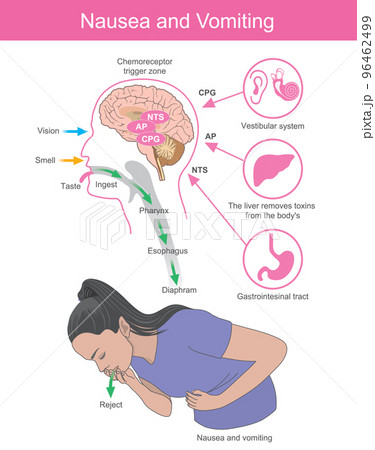Nausea and Vomiting. A woman with symptoms the nausea and vomiting which is the effect of brain processes. Nausea and Vomiting. A woman with symptoms the nausea and vomiting which is the effect of brain processes. 96462499