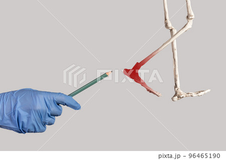 Heel pain, disease of bone shown on skeleton Heel pain, disease of bone shown on skeleton 96465190