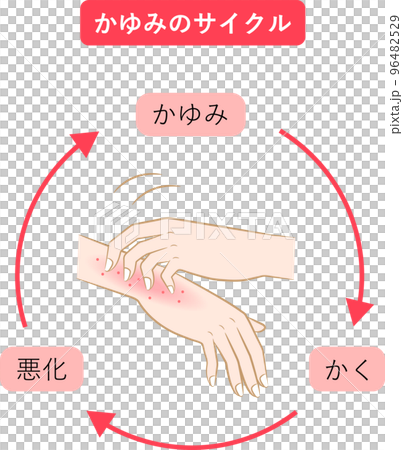 瘙癢週期手部濕疹 瘙癢週期手部濕疹 96482529