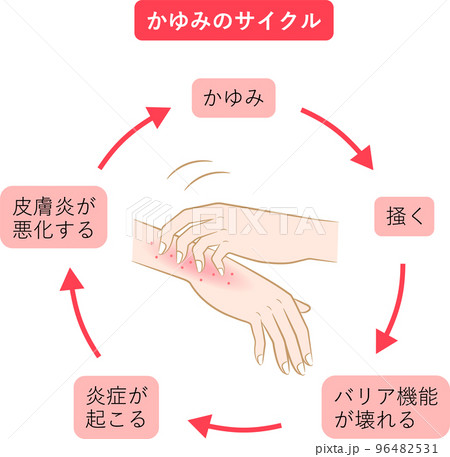 かゆみのサイクル 手湿疹 かゆみのサイクル 手湿疹 96482531