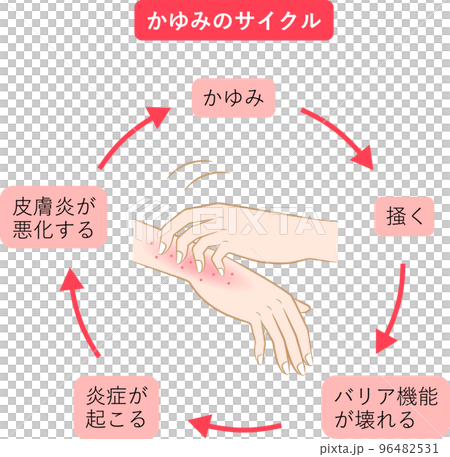 Itching cycle hand eczema 96482531