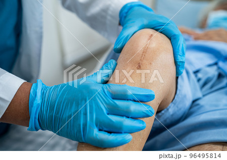 Asian senior or elderly old lady woman patient show her scars surgical total knee joint replacement Suture wound surgery arthroplasty on bed in nursing hospital ward, healthy strong medical concept. Asian senior or elderly old lady woman patient show her scars surgical total knee joint replacement Suture wound surgery arthroplasty on bed in nursing hospital ward, healthy strong medical concept. 96495814