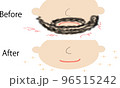 髭脱毛のビフォーアフター 96515242