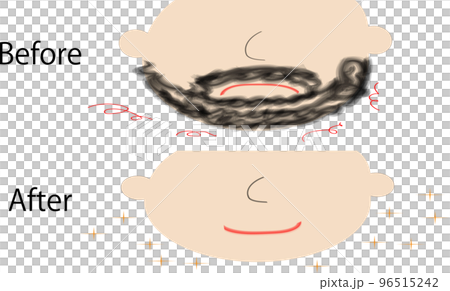 髭脱毛のビフォーアフター 96515242