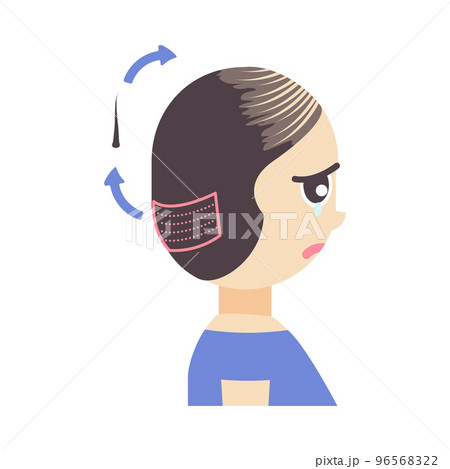 FUE hair transplant treatment of alopecia illustration FUE hair transplant treatment of alopecia illustration 96568322