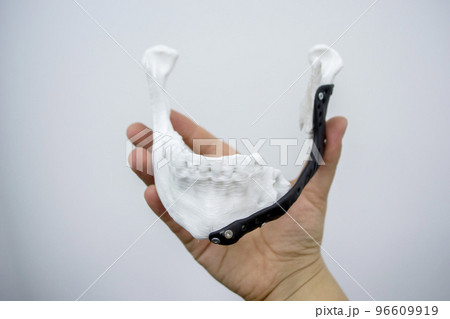 Person holding in hand 3D printed plastic prototype human lower jaw and medical titanium implant close-up. Prosthesis anatomical bone 3D printed from metal powder. Orthopedic maxillo-facial prosthesis 96609919