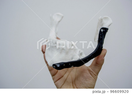 Person holding in hand 3D printed plastic prototype human lower jaw and medical titanium implant close-up. Prosthesis anatomical bone 3D printed from metal powder. Orthopedic maxillo-facial prosthesis 96609920