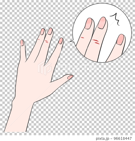 手荒れのイラスト（拡大）　アニメ塗り 96618447