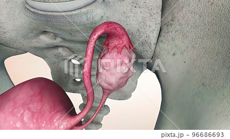 Ovarian cancer cell 3d medical 96686693