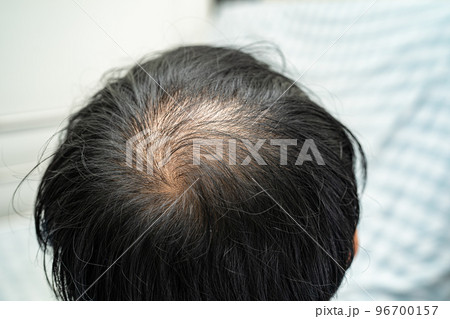 Bald in the middle head and begin no loss hair glabrous of mature Asian business smart active office man. 96700157