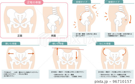 正常な骨盤の位置と歪んだ骨盤の位置と症状を表した図説イラスト 96710157