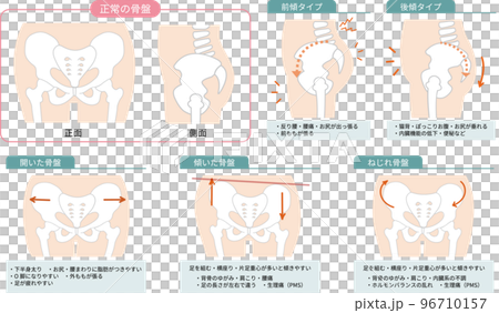 正常な骨盤の位置と歪んだ骨盤の位置と症状を表した図説イラスト 96710157