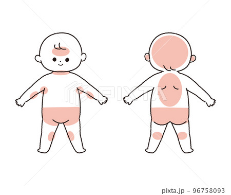 赤ちゃんの汗疹が出来やすい部位を示したイラスト 96758093