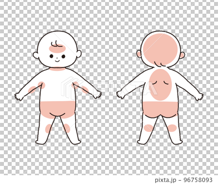 赤ちゃんの汗疹が出来やすい部位を示したイラスト 96758093