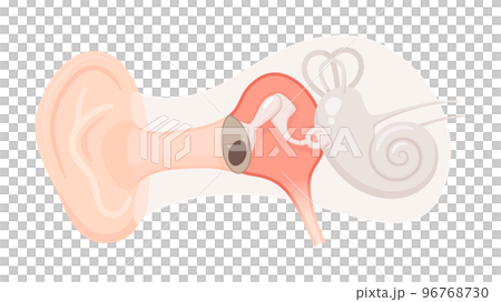 耳の構造のイラスト_慢性中耳炎_鼓膜穿孔 96768730