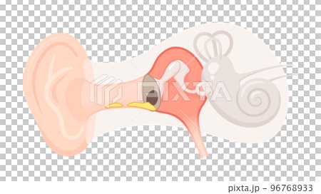 耳の構造のイラスト_慢性中耳炎_鼓膜穿孔と耳漏 96768933