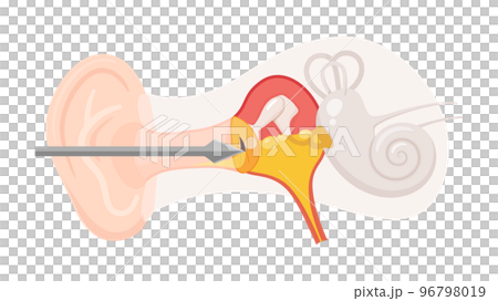 Illustration of tympanostomy for otitis media with effusion 96798019