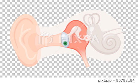 插入耳膜管的插圖_中耳炎 96798194