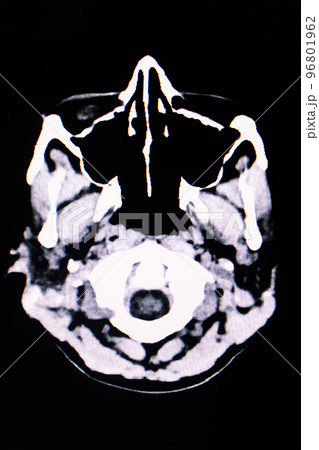 Image of computed tomography of the brain 96801962