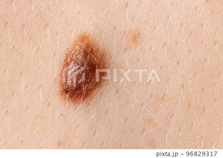 Mole birthmark nevus macro photo on human skin. Close up. 96829317